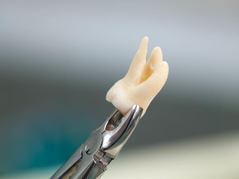 O que é Lente de contato dental? Como funciona e durabilidade