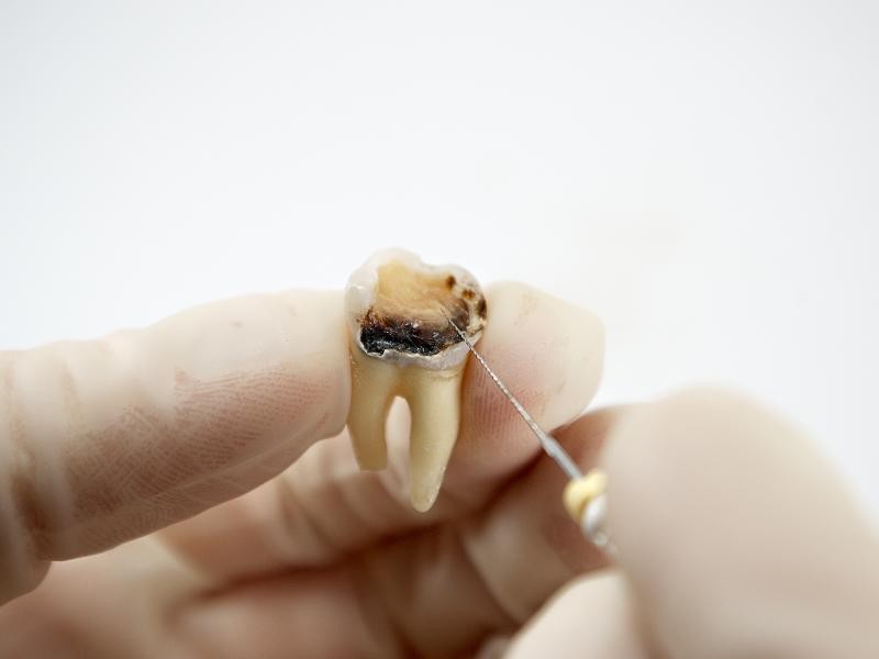 Recuperação após o Tratamento de Canal: Cuidados Essenciais