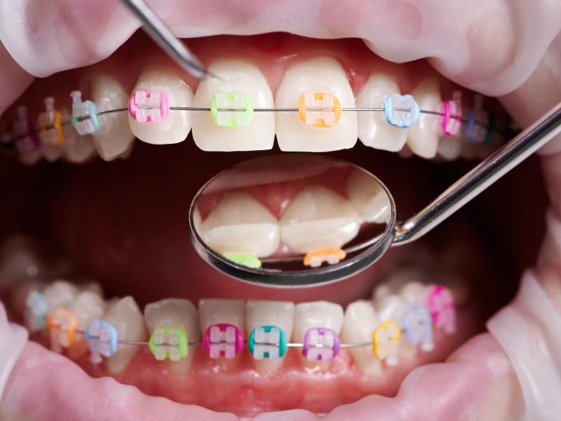 Quando procurar um ortodontista? Sinais de que está na hora